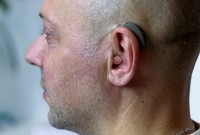 Слухопротезирование