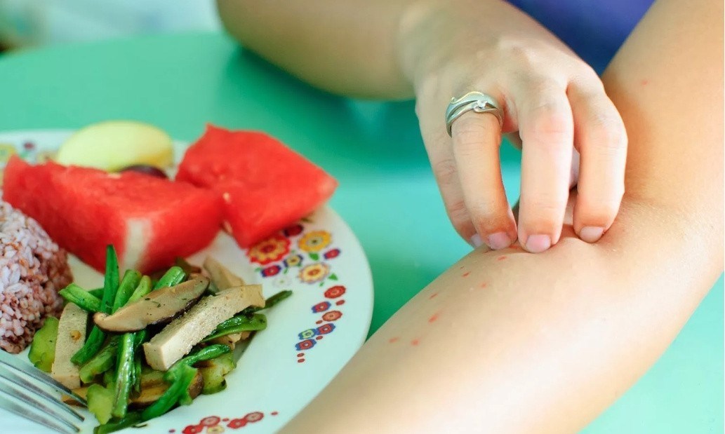 Лечение пищевой аллергии: симптомы и рекомендации