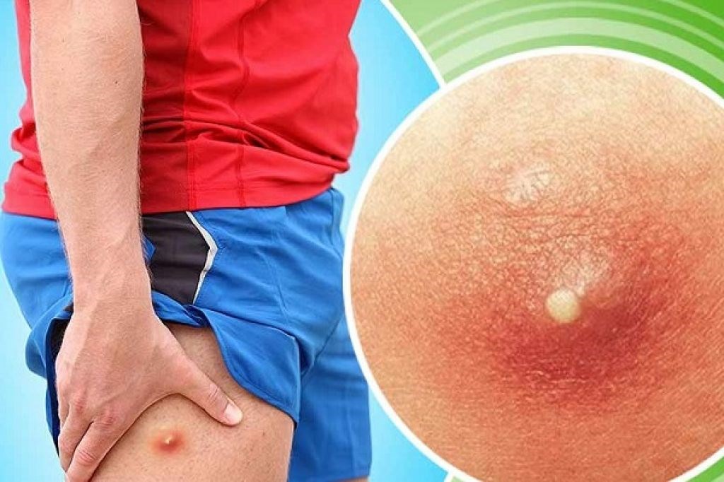 Лечение фурункулеза: причины и профилактика