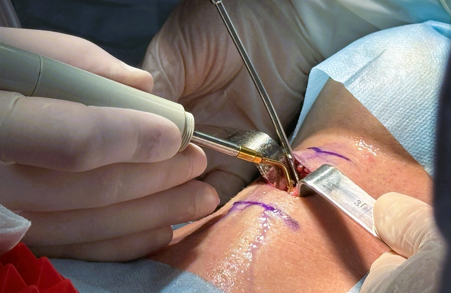 Микрохирургия гортани