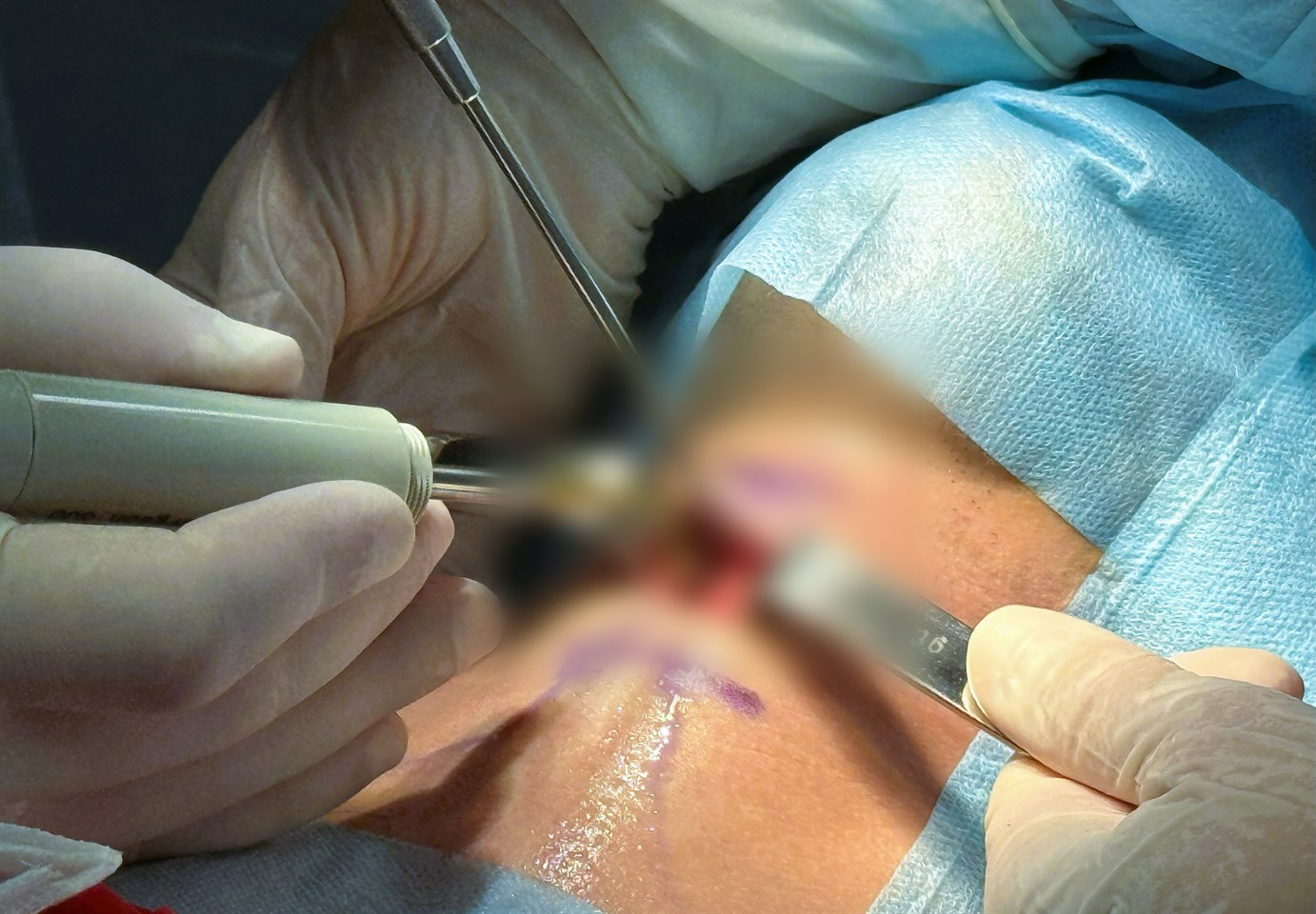 Операции на голосовых связках