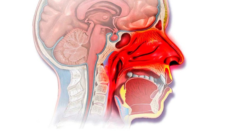 Диагностика и лечение вазомоторного ринита