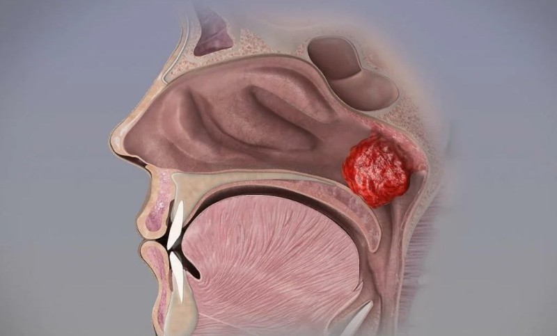 Диагностика и лечение аденоидов