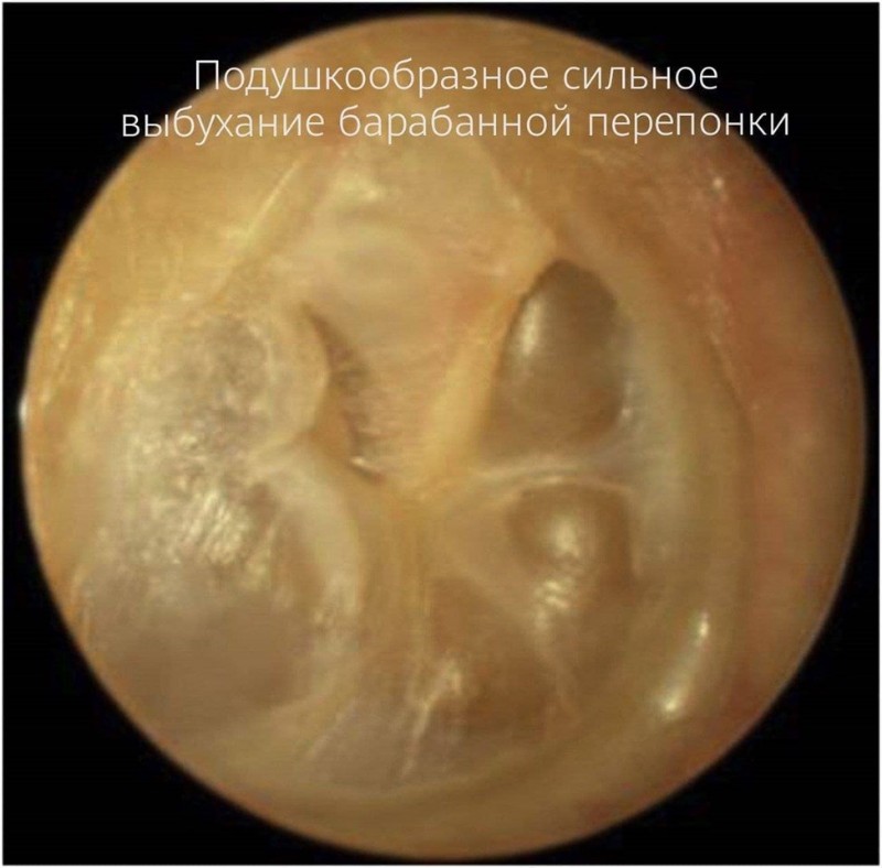 Синдром зияющей слуховой трубы у ребенка 7 лет