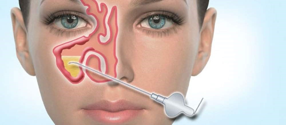 Когда необходимо делать пункцию? 