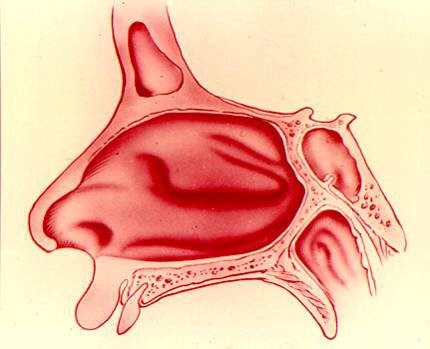 Атрезия хоан