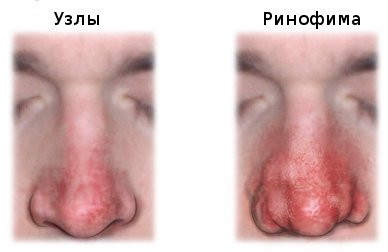 ринофима