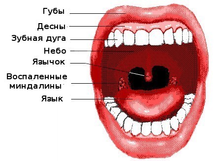 тонзиллит